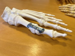 Arthrodese Modell